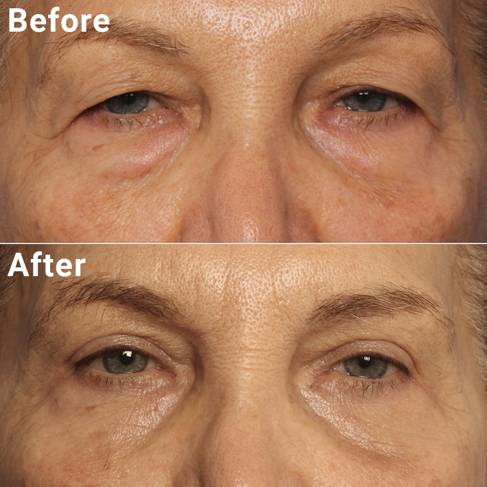 Blepharoplasty