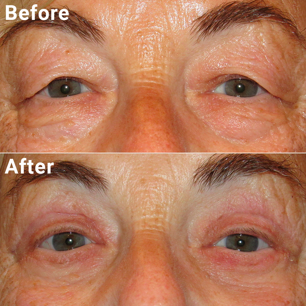 Blepharoplasty