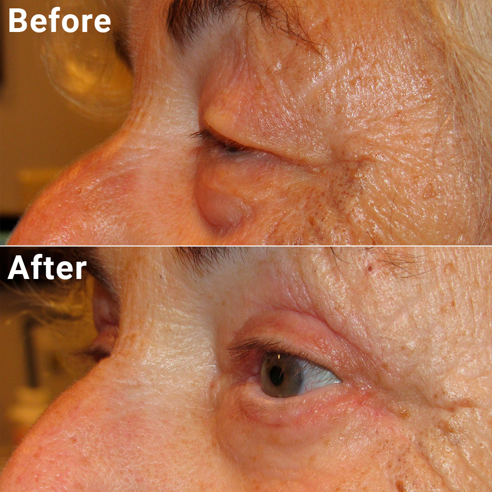 Blepharoplasty