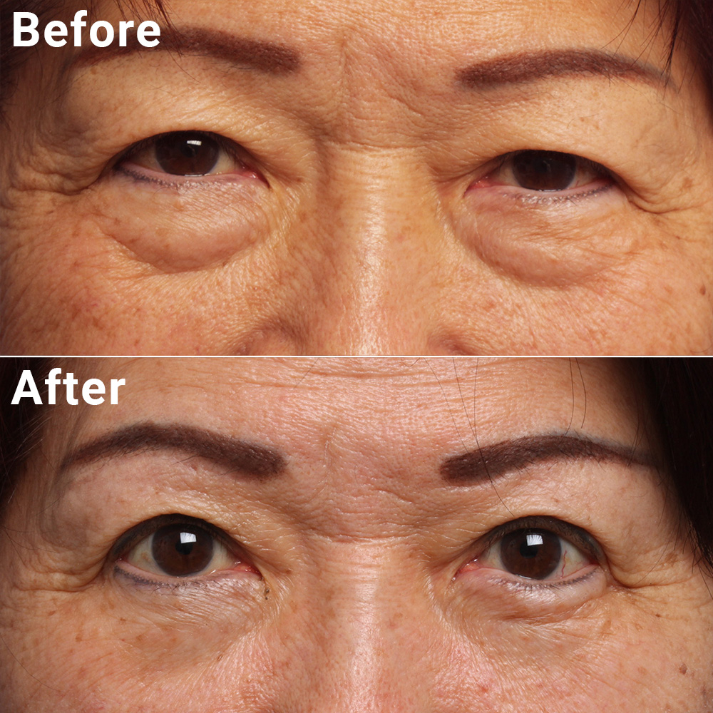 Blepharoplasty