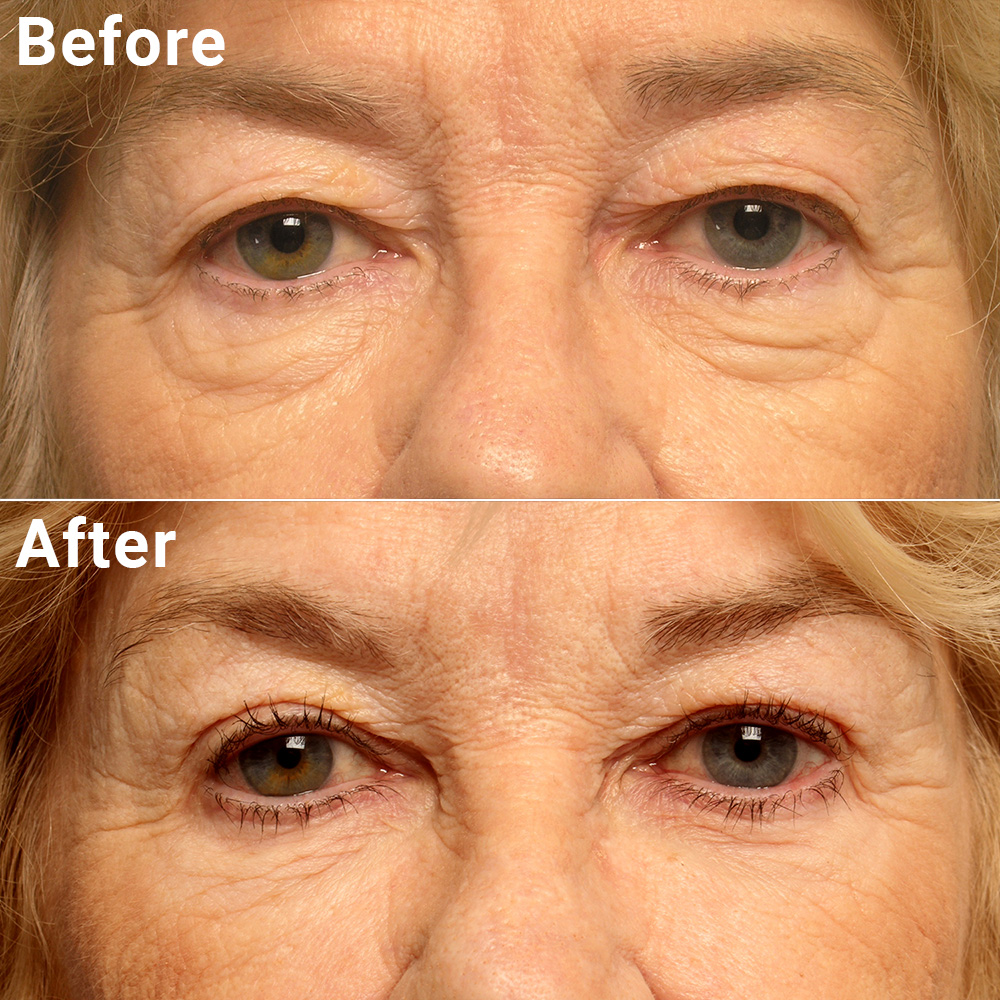 Blepharoplasty