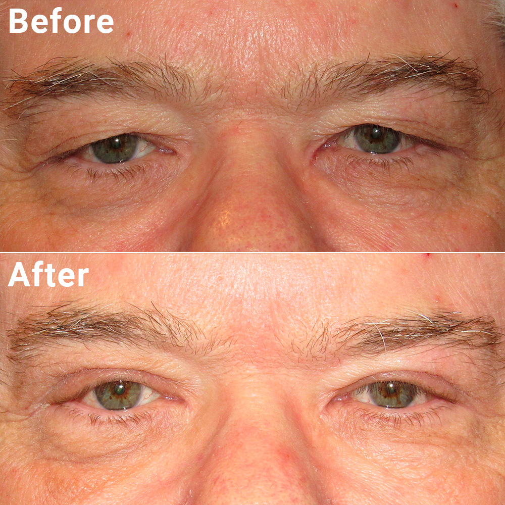 Blepharoplasty