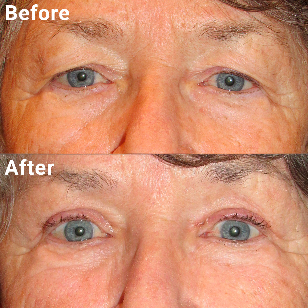 Blepharoplasty