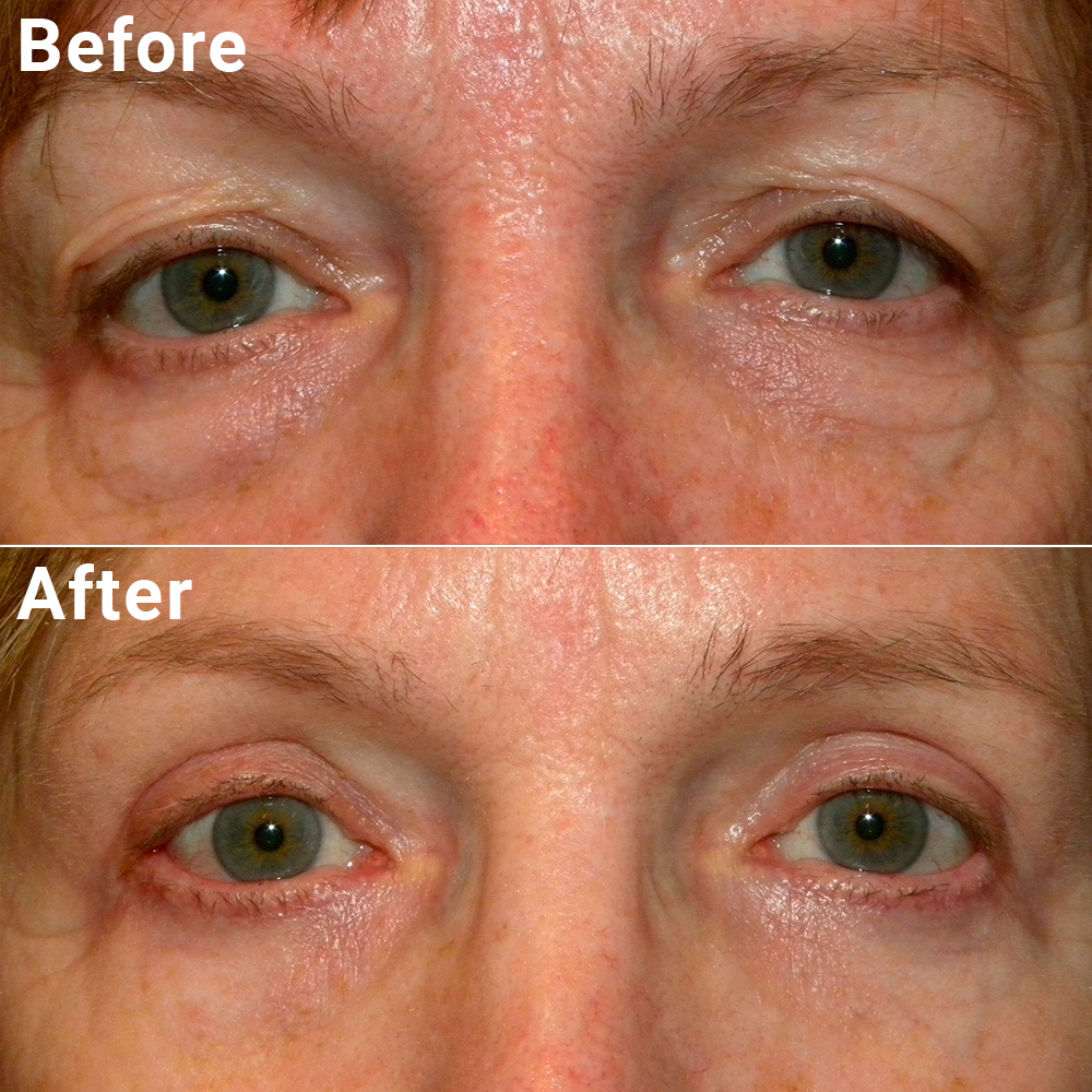 Blepharoplasty