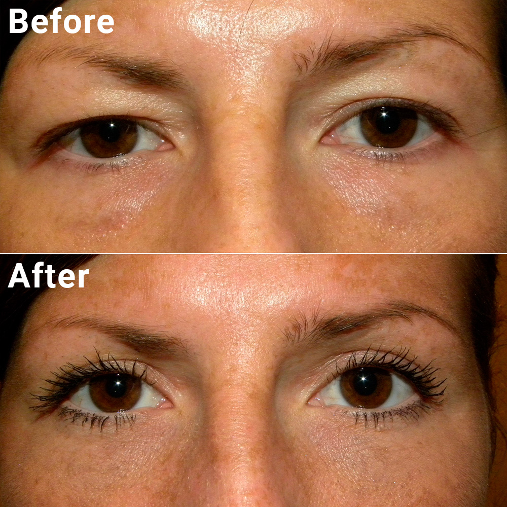 Blepharoplasty