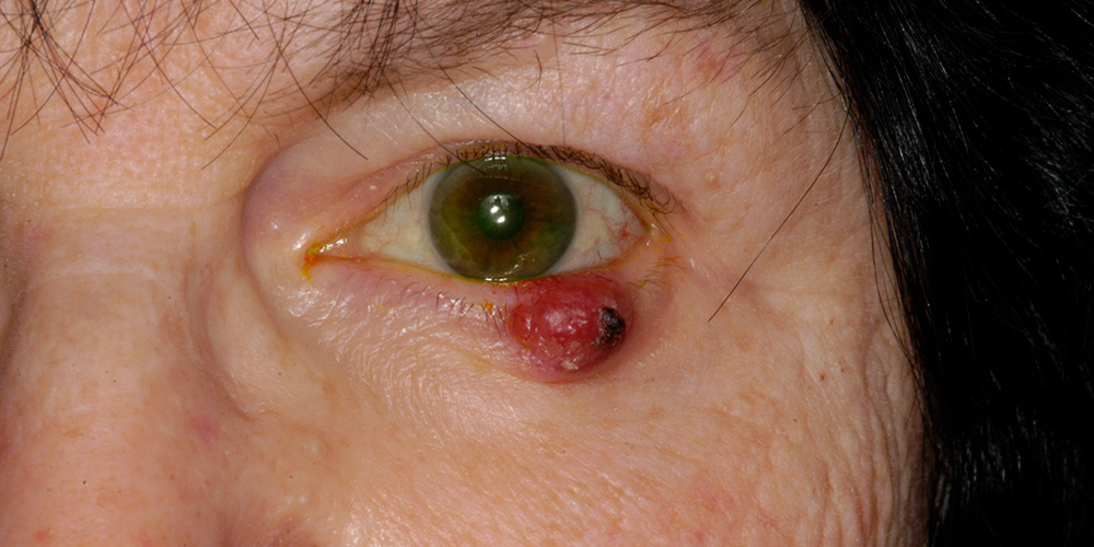 Skin Cancer On Eyelid Symptoms