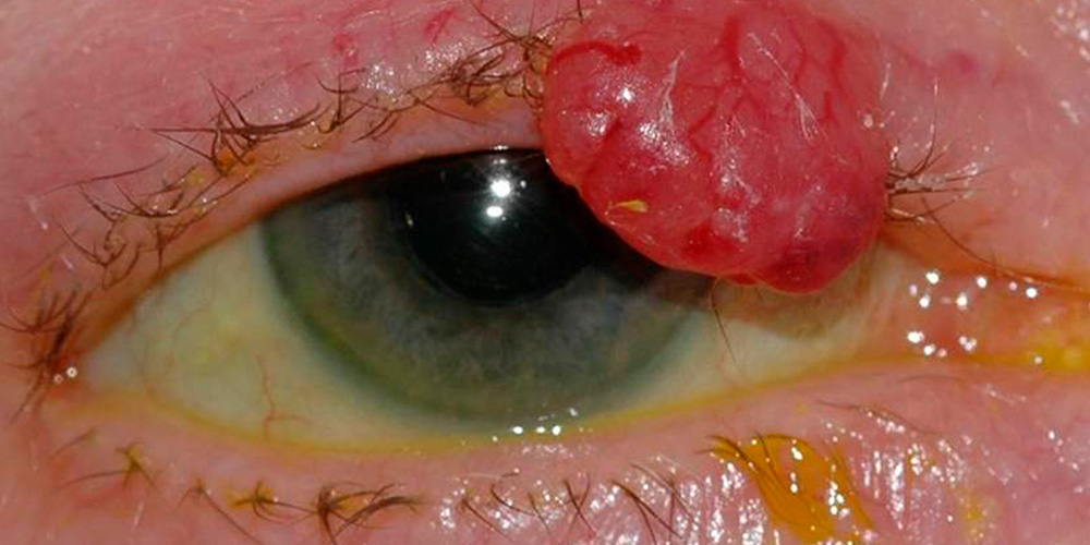 Eyelid Skin Cancer