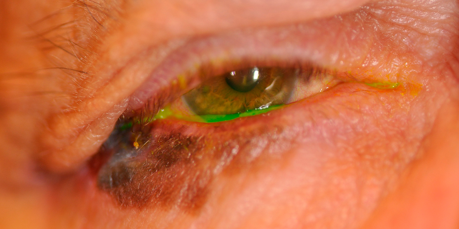 Eyelid Skin Cancer