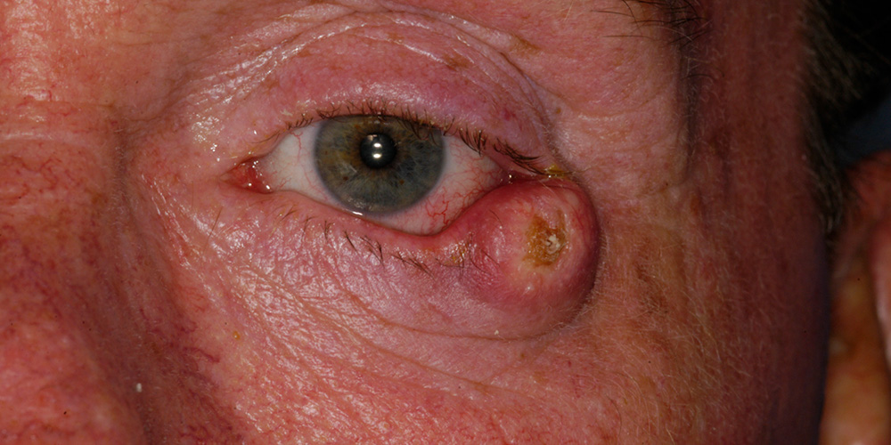 Eyelid Skin Cancer
