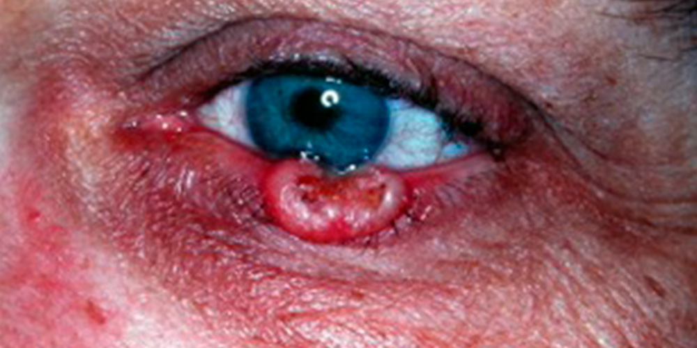 Eyelid Skin Cancer