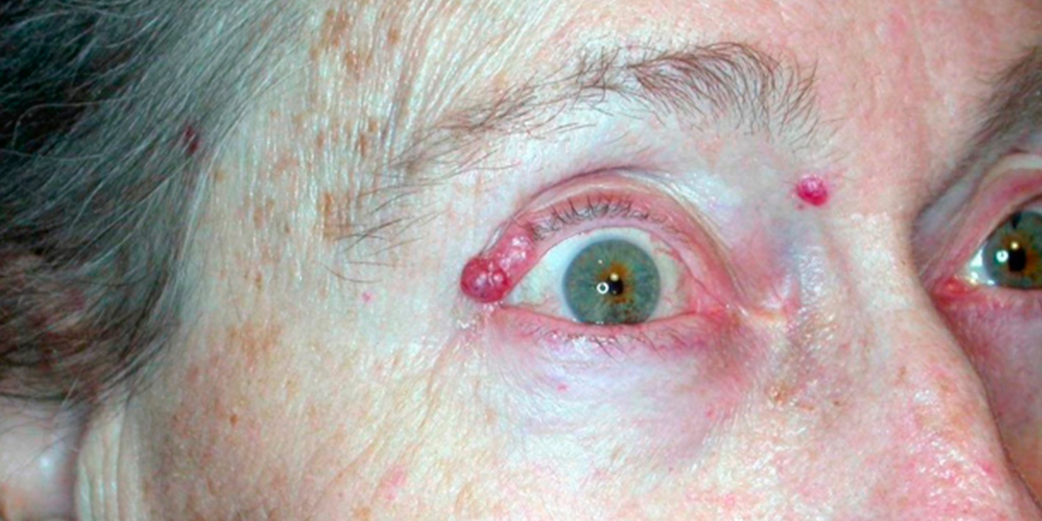 Eyelid Skin Cancer