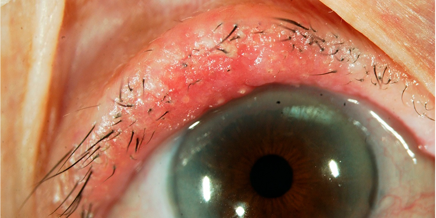 Eyelid Skin Cancer