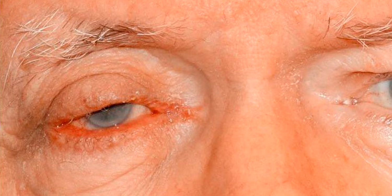 Eyelid Skin Cancer