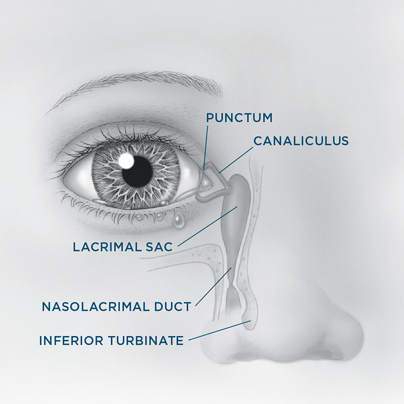 congenital lacrimal obstruction