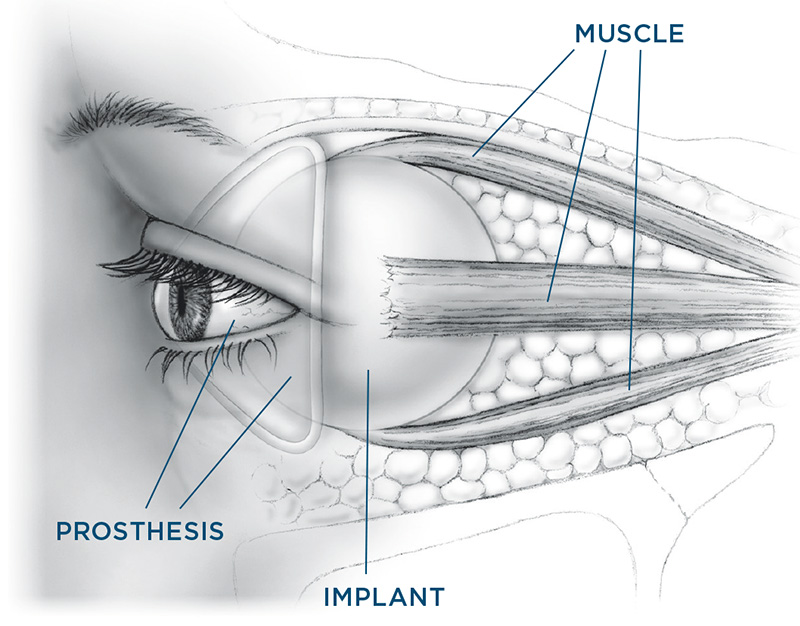 Enucleation