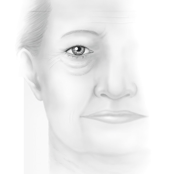 Face and Neck Lift