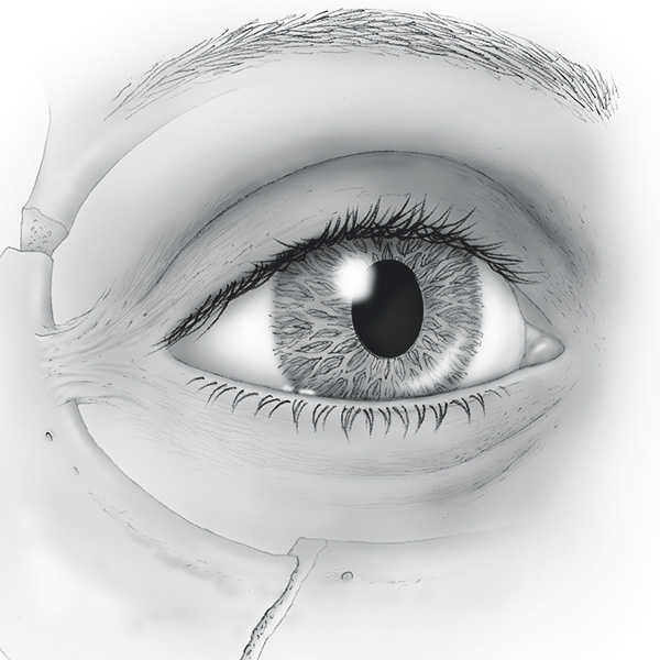 Eye Socket Fracture